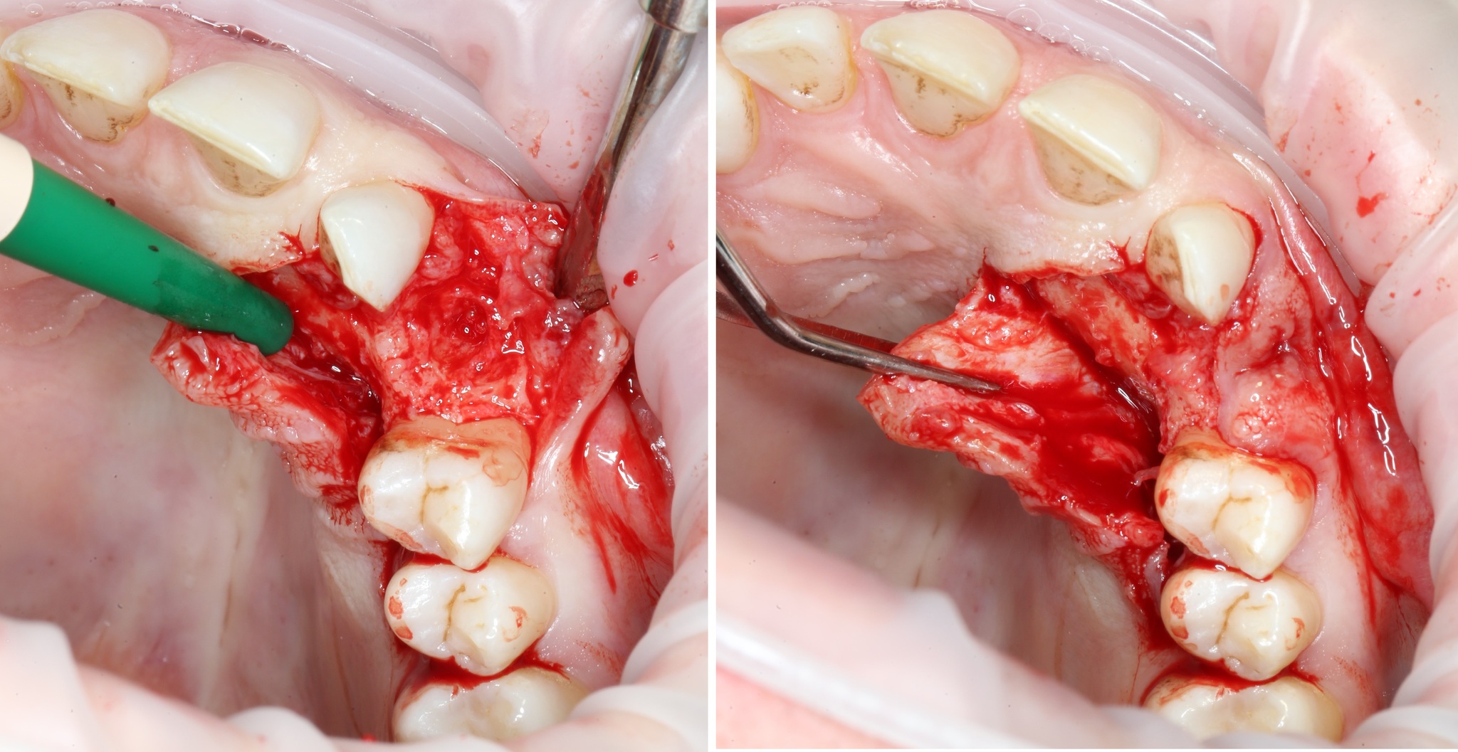 Removing an impacted canine: how is it done? - My, Teeth, The medicine, Operation, Polyclinic, Dental implantation, Удаление, Extraction of teeth, Mat, Longpost, Dentist, Doctors