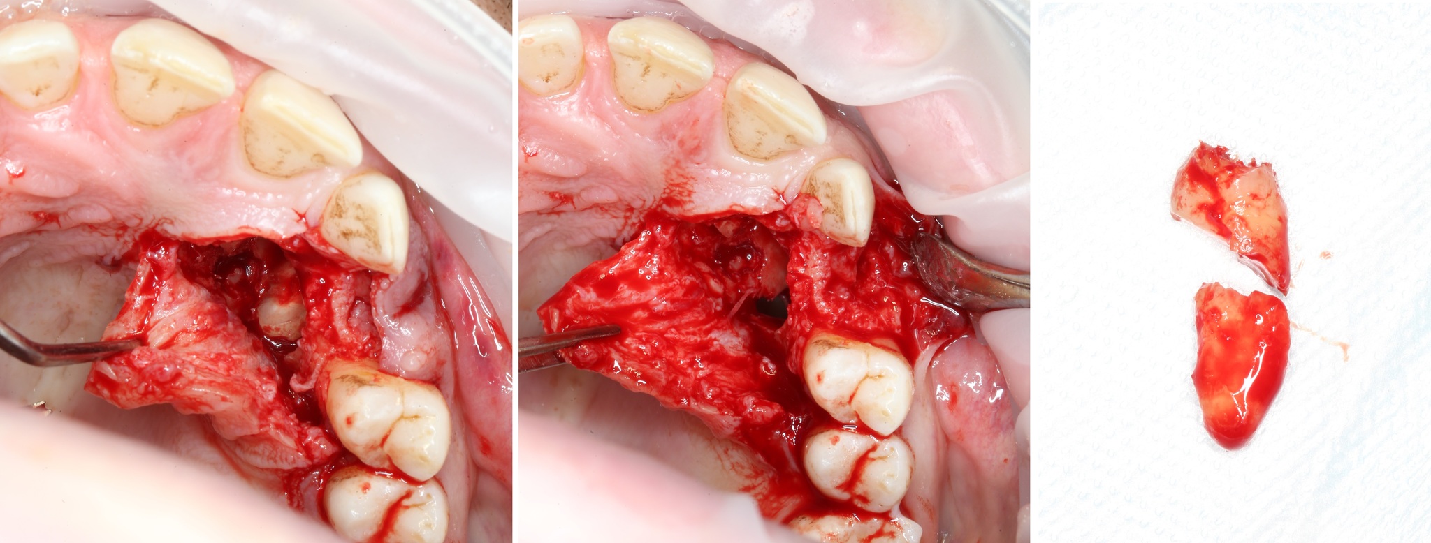 Removing an impacted canine: how is it done? - My, Teeth, The medicine, Operation, Polyclinic, Dental implantation, Удаление, Extraction of teeth, Mat, Longpost, Dentist, Doctors