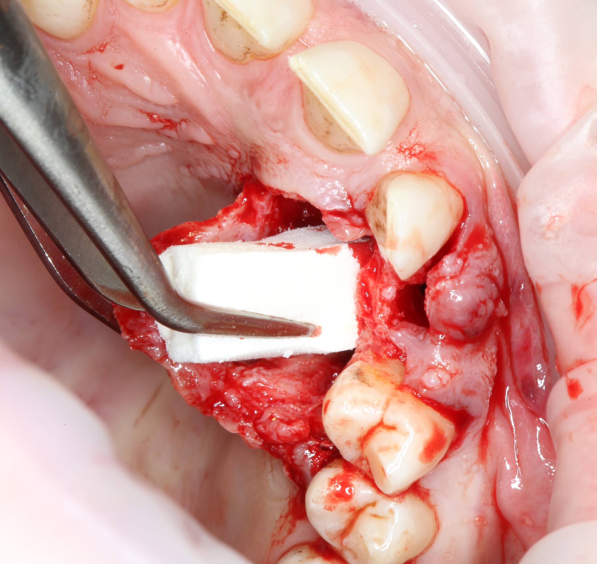 Removing an impacted canine: how is it done? - My, Teeth, The medicine, Operation, Polyclinic, Dental implantation, Удаление, Extraction of teeth, Mat, Longpost, Dentist, Doctors