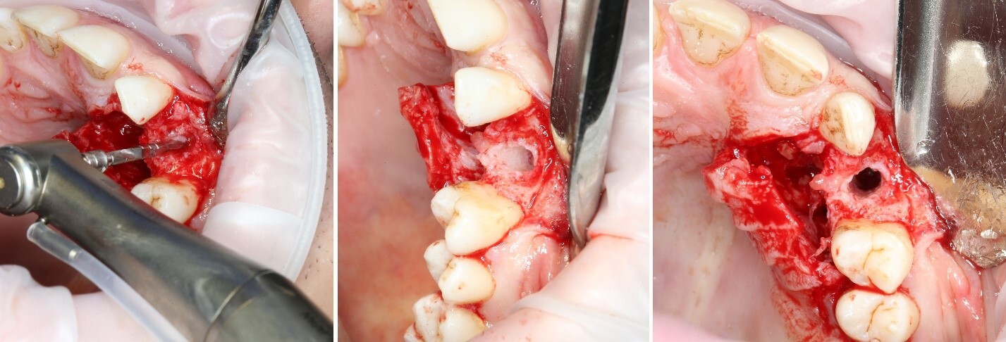 Removing an impacted canine: how is it done? - My, Teeth, The medicine, Operation, Polyclinic, Dental implantation, Удаление, Extraction of teeth, Mat, Longpost, Dentist, Doctors