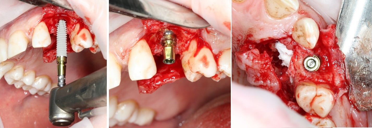 Removing an impacted canine: how is it done? - My, Teeth, The medicine, Operation, Polyclinic, Dental implantation, Удаление, Extraction of teeth, Mat, Longpost, Dentist, Doctors