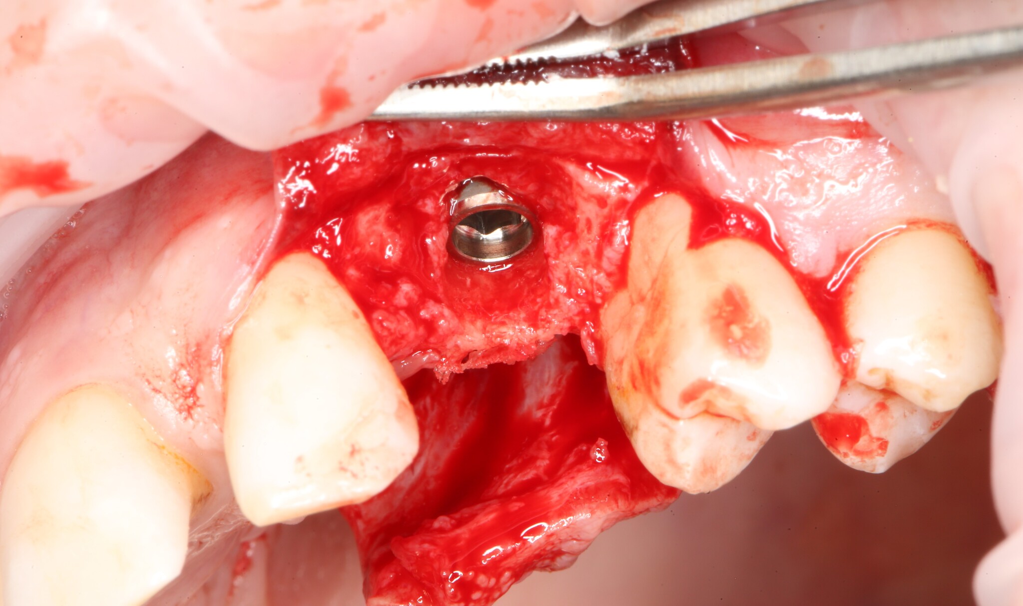 Removing an impacted canine: how is it done? - My, Teeth, The medicine, Operation, Polyclinic, Dental implantation, Удаление, Extraction of teeth, Mat, Longpost, Dentist, Doctors