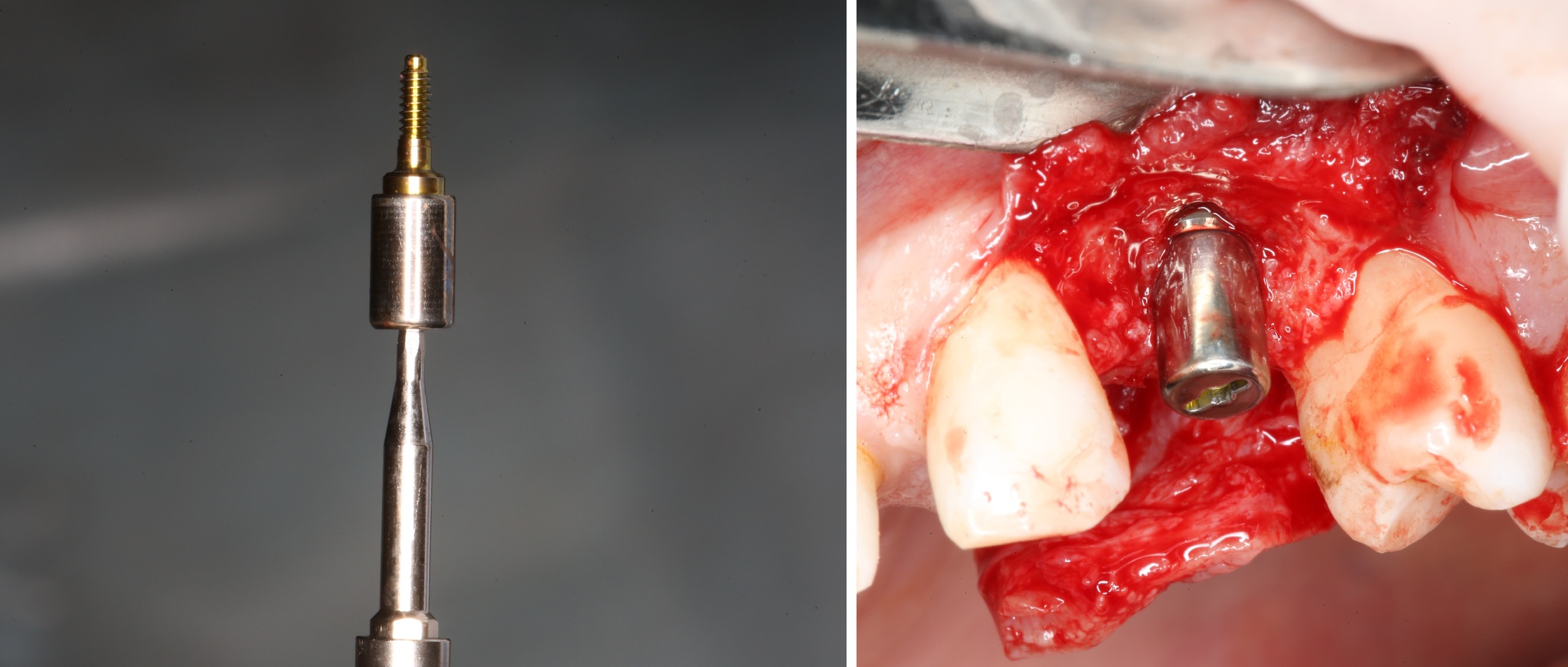 Removing an impacted canine: how is it done? - My, Teeth, The medicine, Operation, Polyclinic, Dental implantation, Удаление, Extraction of teeth, Mat, Longpost, Dentist, Doctors