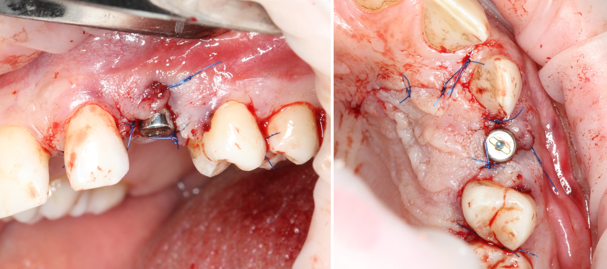 Removing an impacted canine: how is it done? - My, Teeth, The medicine, Operation, Polyclinic, Dental implantation, Удаление, Extraction of teeth, Mat, Longpost, Dentist, Doctors