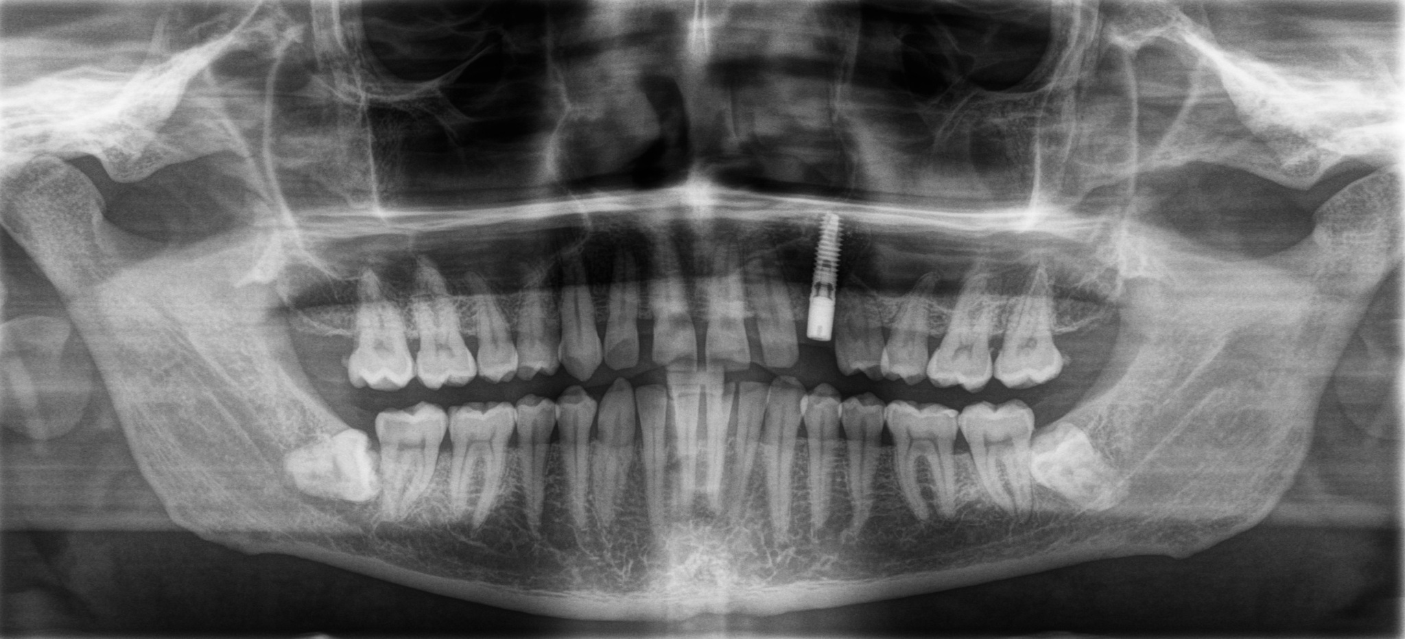 Removing an impacted canine: how is it done? - My, Teeth, The medicine, Operation, Polyclinic, Dental implantation, Удаление, Extraction of teeth, Mat, Longpost, Dentist, Doctors