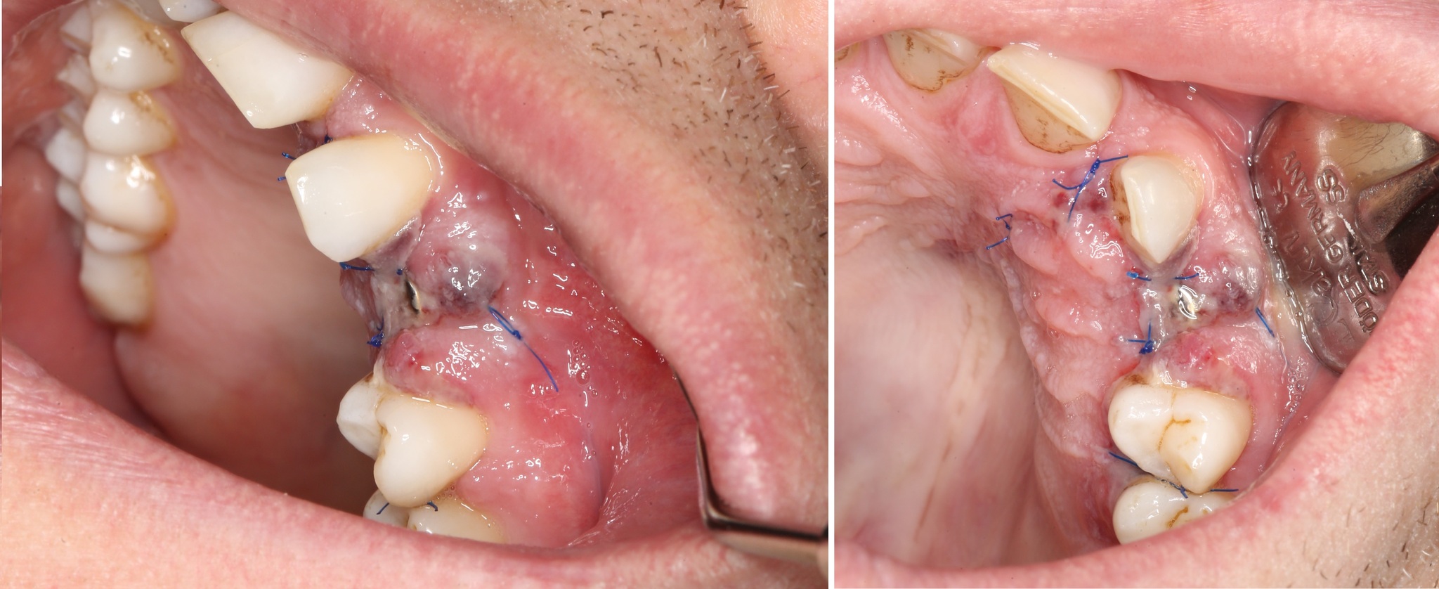 Removing an impacted canine: how is it done? - My, Teeth, The medicine, Operation, Polyclinic, Dental implantation, Удаление, Extraction of teeth, Mat, Longpost, Dentist, Doctors