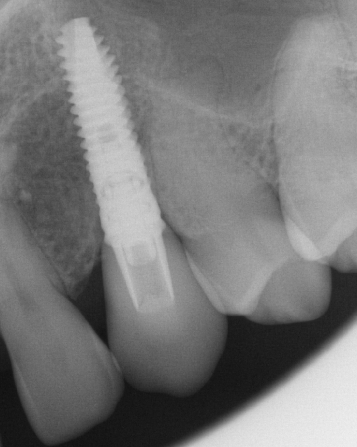 Removing an impacted canine: how is it done? - My, Teeth, The medicine, Operation, Polyclinic, Dental implantation, Удаление, Extraction of teeth, Mat, Longpost, Dentist, Doctors