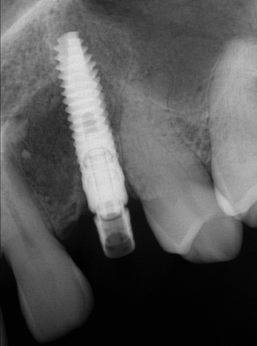 Removing an impacted canine: how is it done? - My, Teeth, The medicine, Operation, Polyclinic, Dental implantation, Удаление, Extraction of teeth, Mat, Longpost, Dentist, Doctors