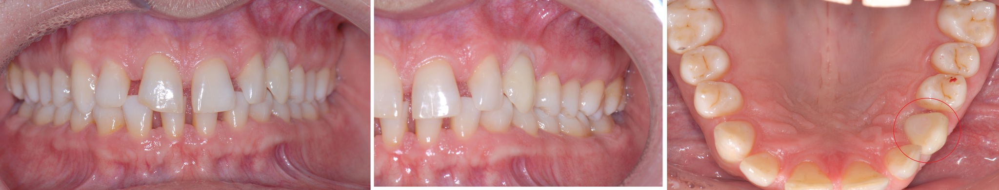 Removing an impacted canine: how is it done? - My, Teeth, The medicine, Operation, Polyclinic, Dental implantation, Удаление, Extraction of teeth, Mat, Longpost, Dentist, Doctors