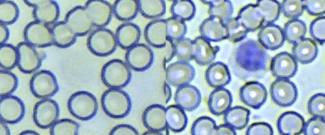 Анализ крови своими руками - Моё, Медицина, Микроскоп, Кровь, Длиннопост, Анализ, Медицинские анализы