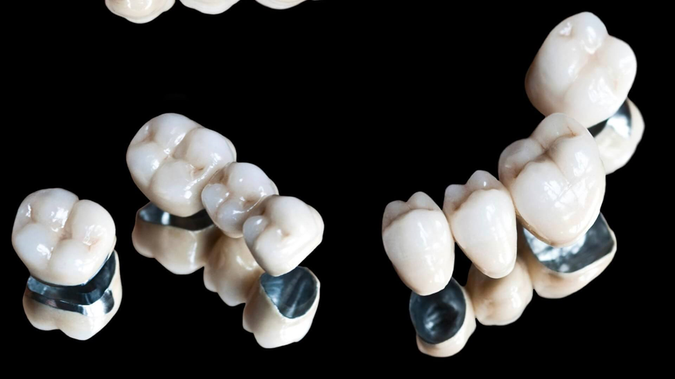 A saga about dentistry. Chapter 86. Which crowns are better? - My, Dentistry, Doctors, The medicine, Health, Answer, Crowns, Teeth, Prosthetics, Polyclinic, Treatment, Ceramics, Question, Material, Dentist, Choice, Longpost