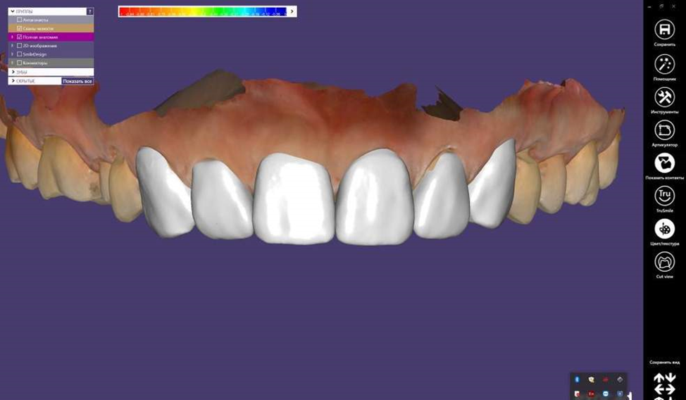 A saga about dentistry. Chapter 86. Which crowns are better? - My, Dentistry, Doctors, The medicine, Health, Answer, Crowns, Teeth, Prosthetics, Polyclinic, Treatment, Ceramics, Question, Material, Dentist, Choice, Longpost