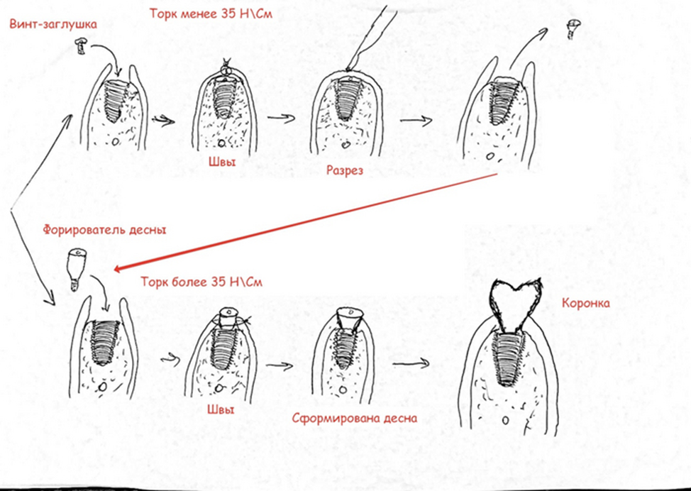 A saga about dentistry. Chapter 88. How to install a crown on a dental implant? - My, Dentistry, The medicine, Doctors, Health, Operation, Prosthesis, Crown, Teeth, Polyclinic, Implants, Dental implantation, Dentist, Ceramics, Spare parts, Question, Longpost