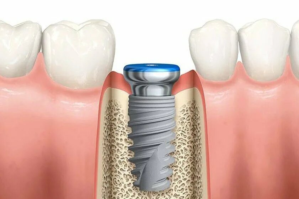 A saga about dentistry. Chapter 88. How to install a crown on a dental implant? - My, Dentistry, The medicine, Doctors, Health, Operation, Prosthesis, Crown, Teeth, Polyclinic, Implants, Dental implantation, Dentist, Ceramics, Spare parts, Question, Longpost