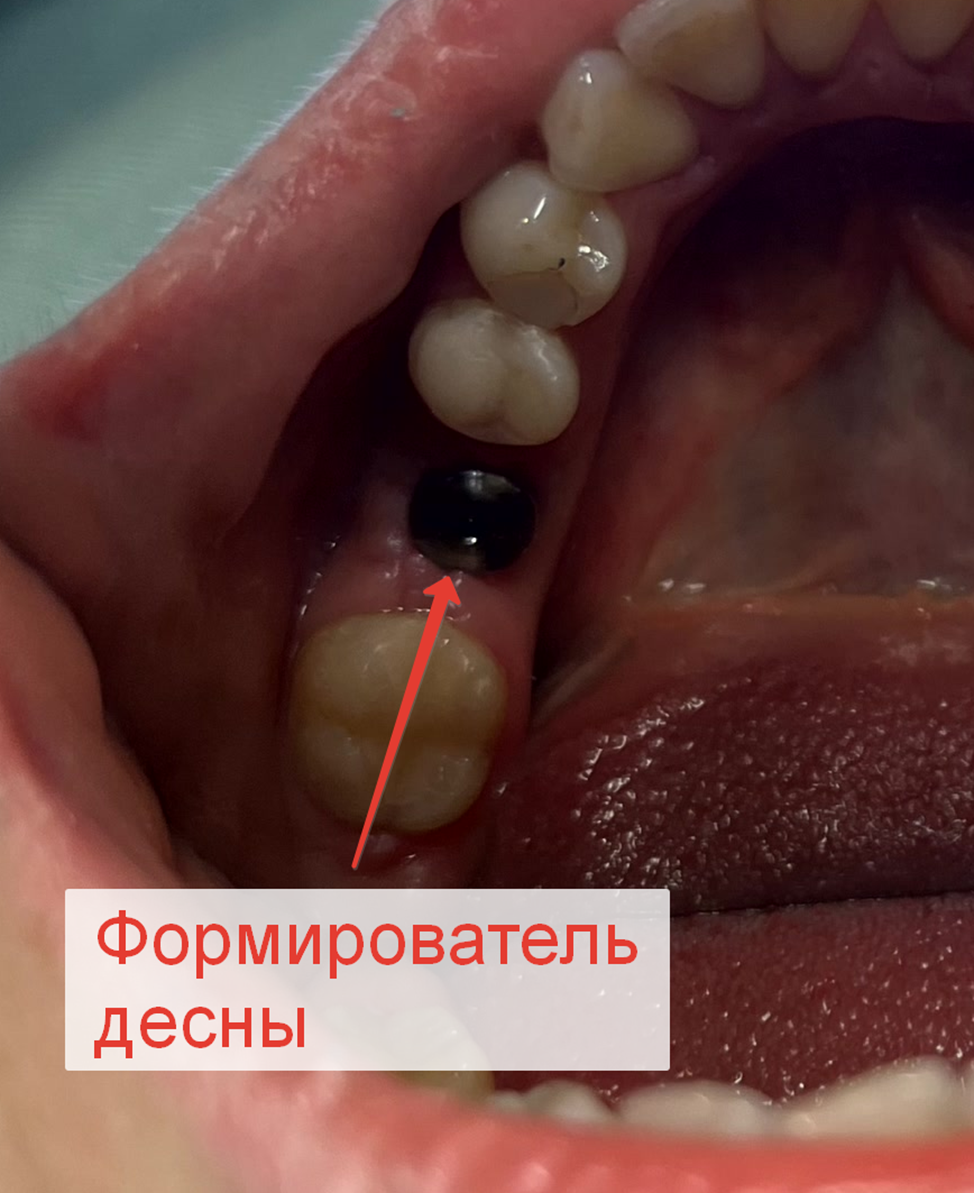 A saga about dentistry. Chapter 88. How to install a crown on a dental implant? - My, Dentistry, The medicine, Doctors, Health, Operation, Prosthesis, Crown, Teeth, Polyclinic, Implants, Dental implantation, Dentist, Ceramics, Spare parts, Question, Longpost