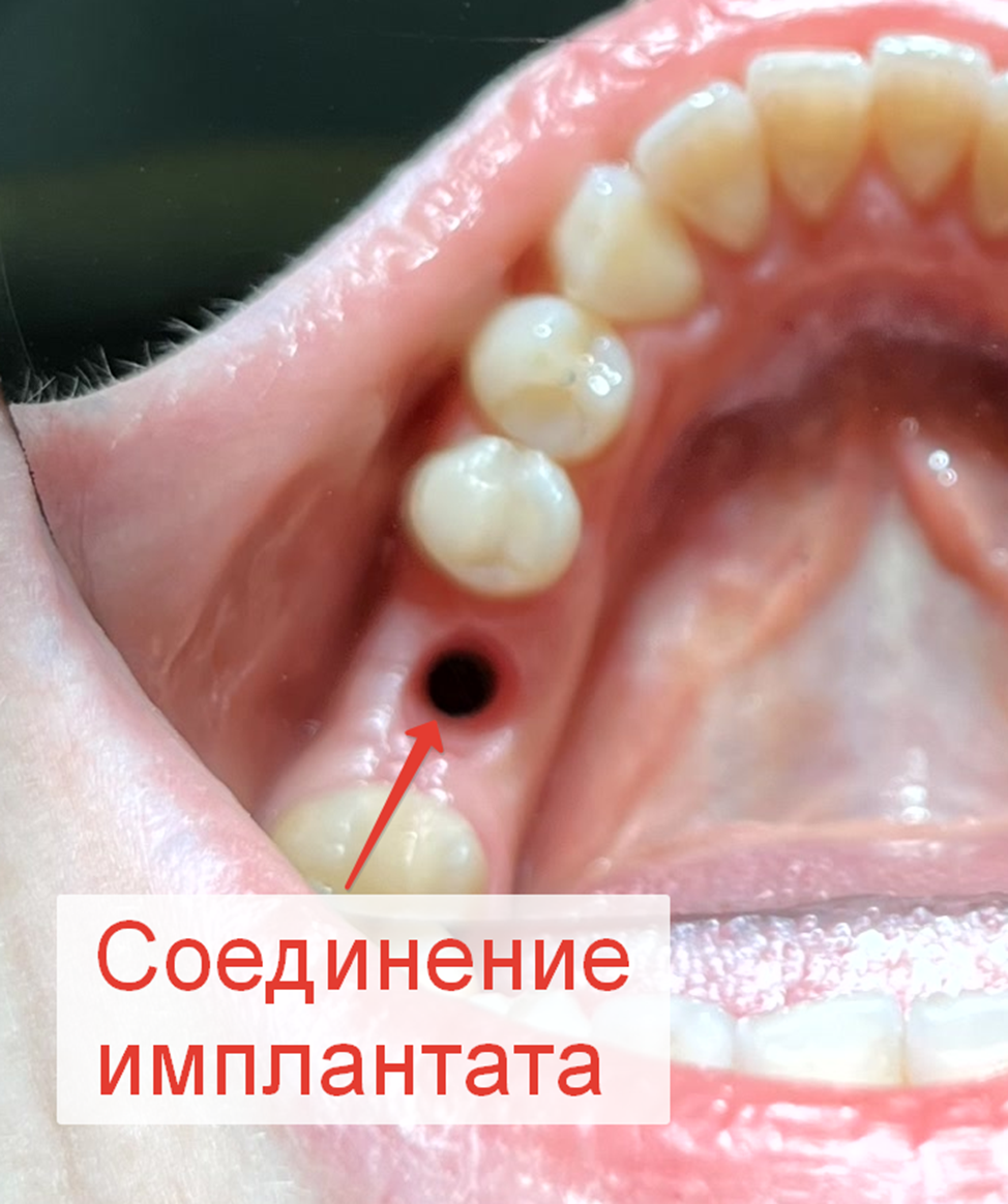 A saga about dentistry. Chapter 88. How to install a crown on a dental implant? - My, Dentistry, The medicine, Doctors, Health, Operation, Prosthesis, Crown, Teeth, Polyclinic, Implants, Dental implantation, Dentist, Ceramics, Spare parts, Question, Longpost