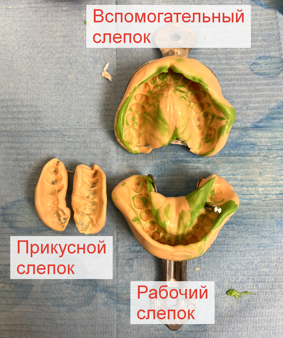 A saga about dentistry. Chapter 88. How to install a crown on a dental implant? - My, Dentistry, The medicine, Doctors, Health, Operation, Prosthesis, Crown, Teeth, Polyclinic, Implants, Dental implantation, Dentist, Ceramics, Spare parts, Question, Longpost