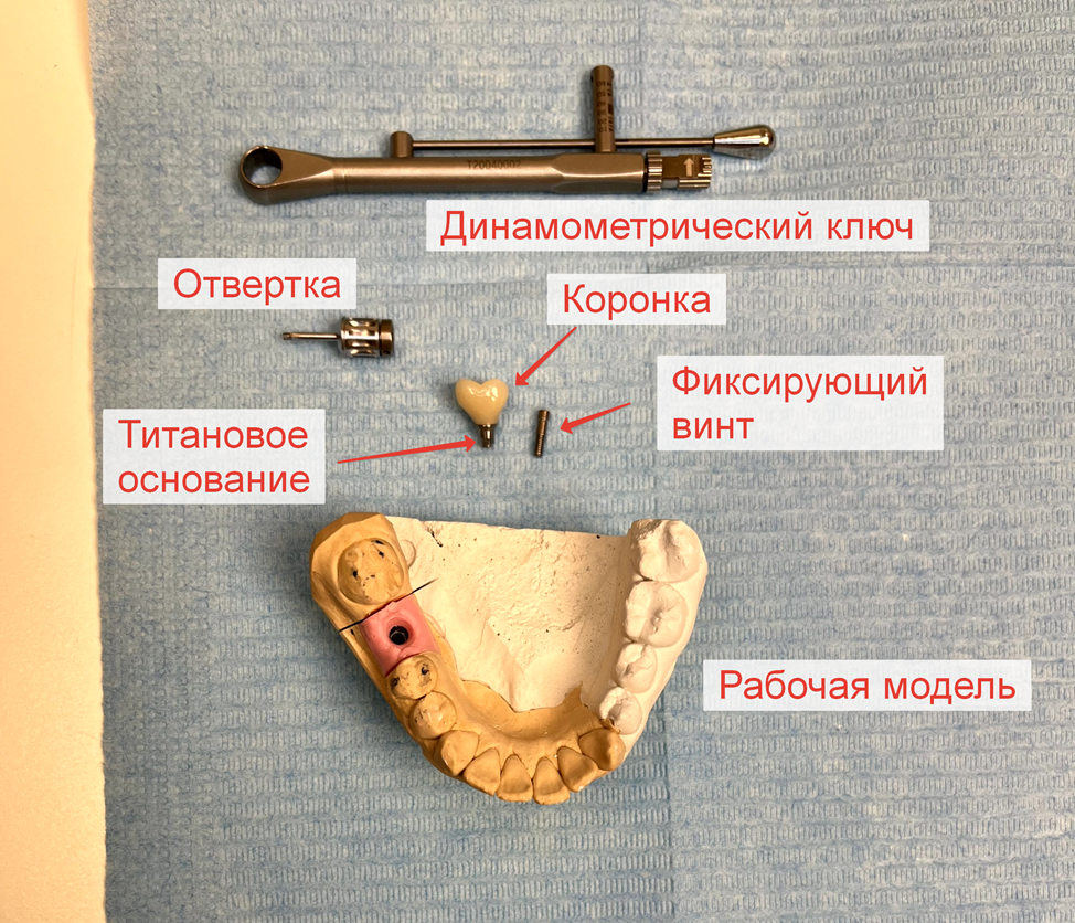 A saga about dentistry. Chapter 88. How to install a crown on a dental implant? - My, Dentistry, The medicine, Doctors, Health, Operation, Prosthesis, Crown, Teeth, Polyclinic, Implants, Dental implantation, Dentist, Ceramics, Spare parts, Question, Longpost