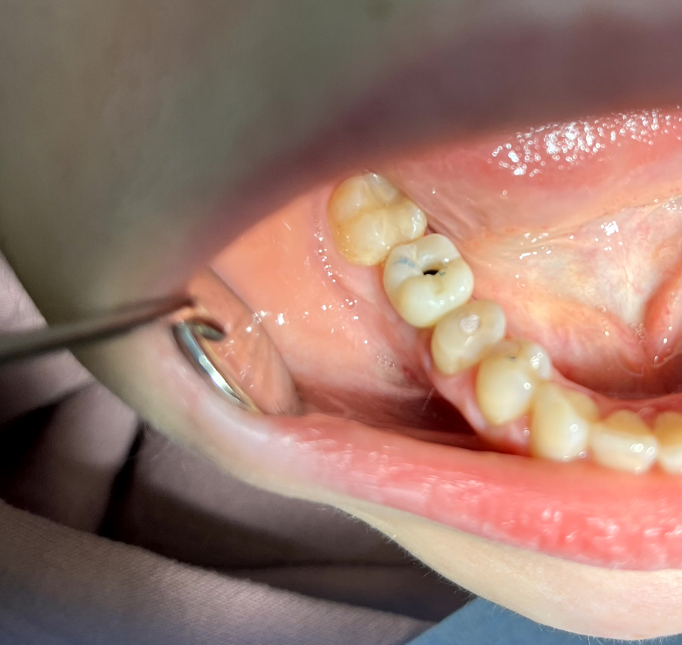 A saga about dentistry. Chapter 88. How to install a crown on a dental implant? - My, Dentistry, The medicine, Doctors, Health, Operation, Prosthesis, Crown, Teeth, Polyclinic, Implants, Dental implantation, Dentist, Ceramics, Spare parts, Question, Longpost