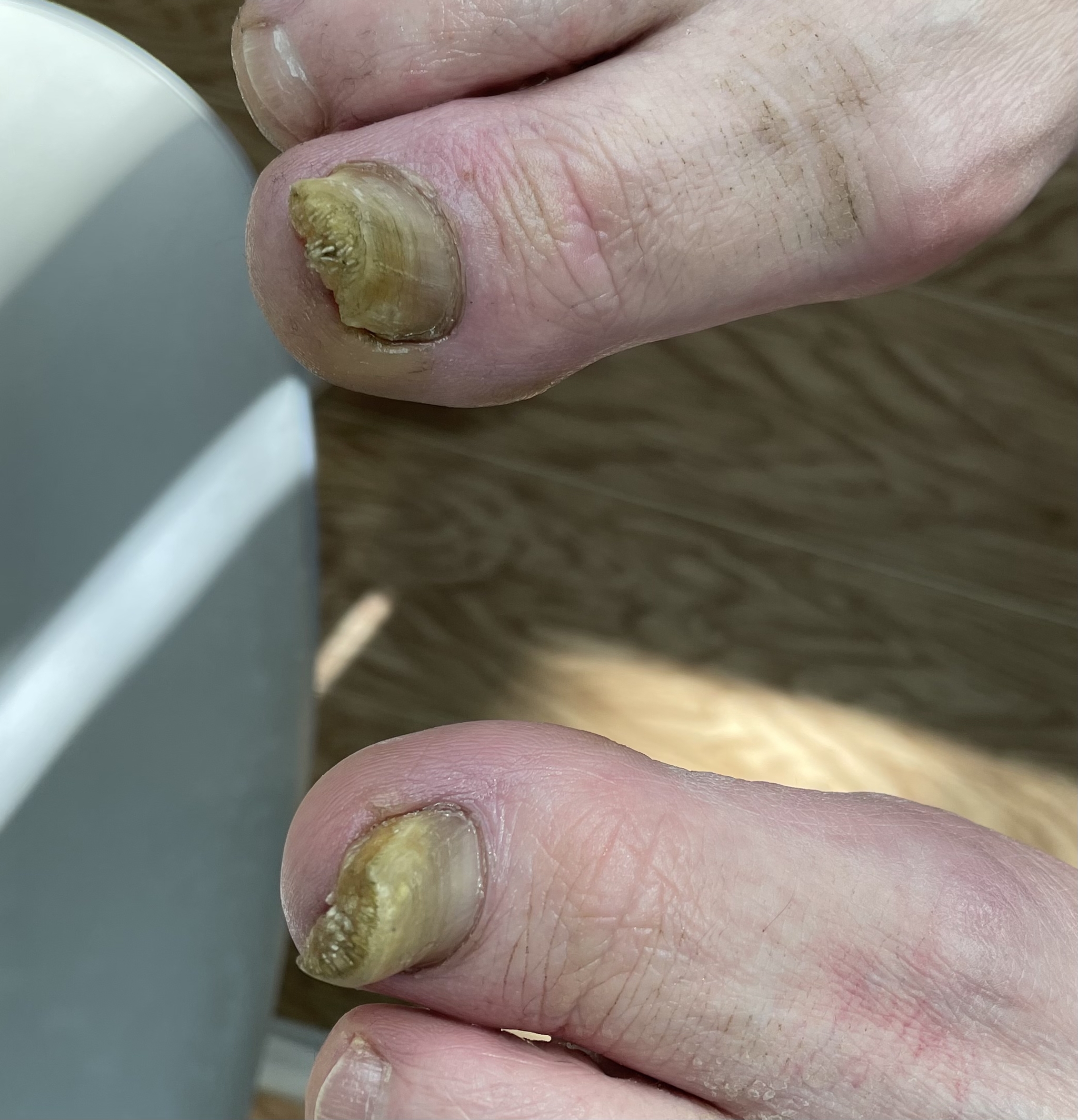 Onychomycosis - My, Podology, Pedicure, Fungus, Health, Longpost