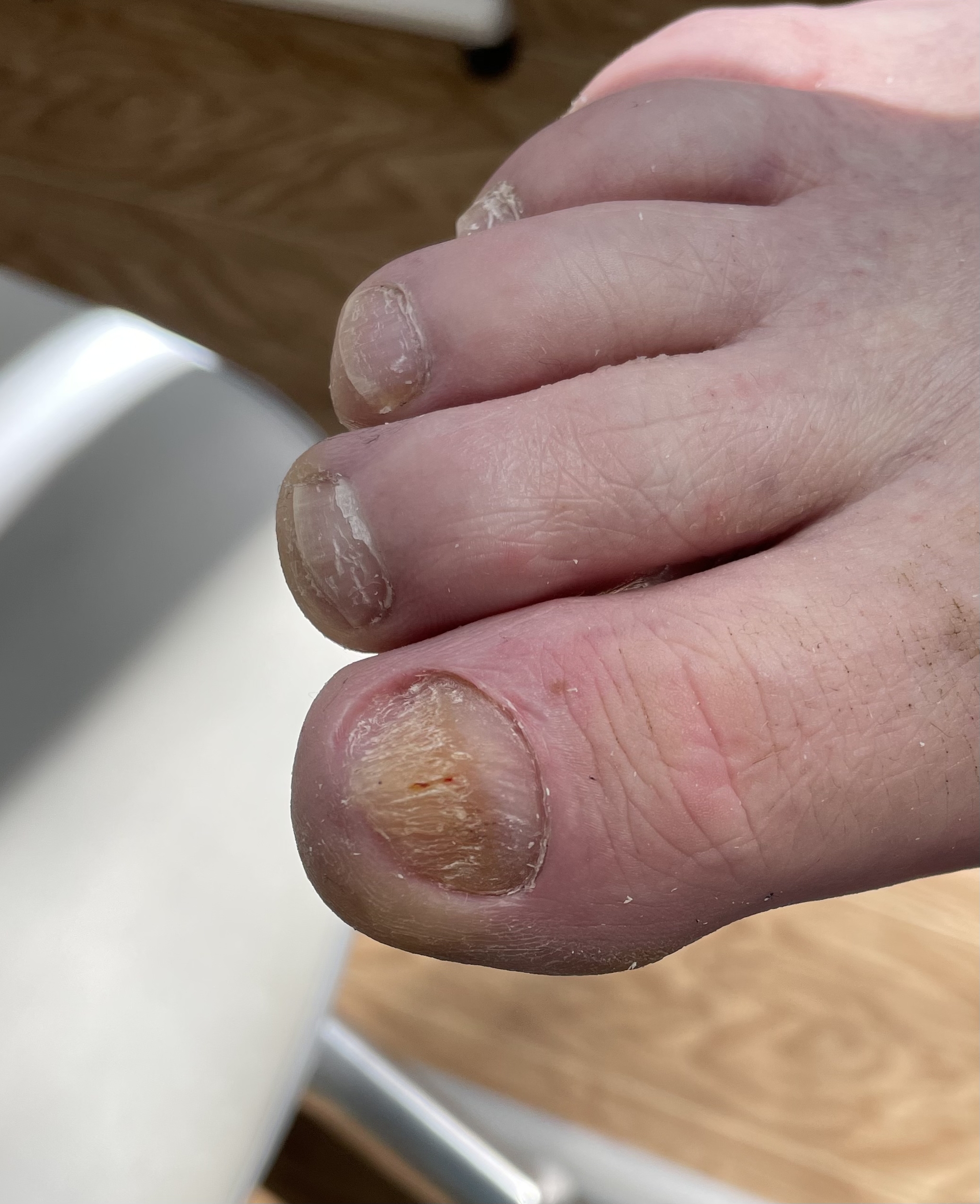 Onychomycosis - My, Podology, Pedicure, Fungus, Health, Longpost