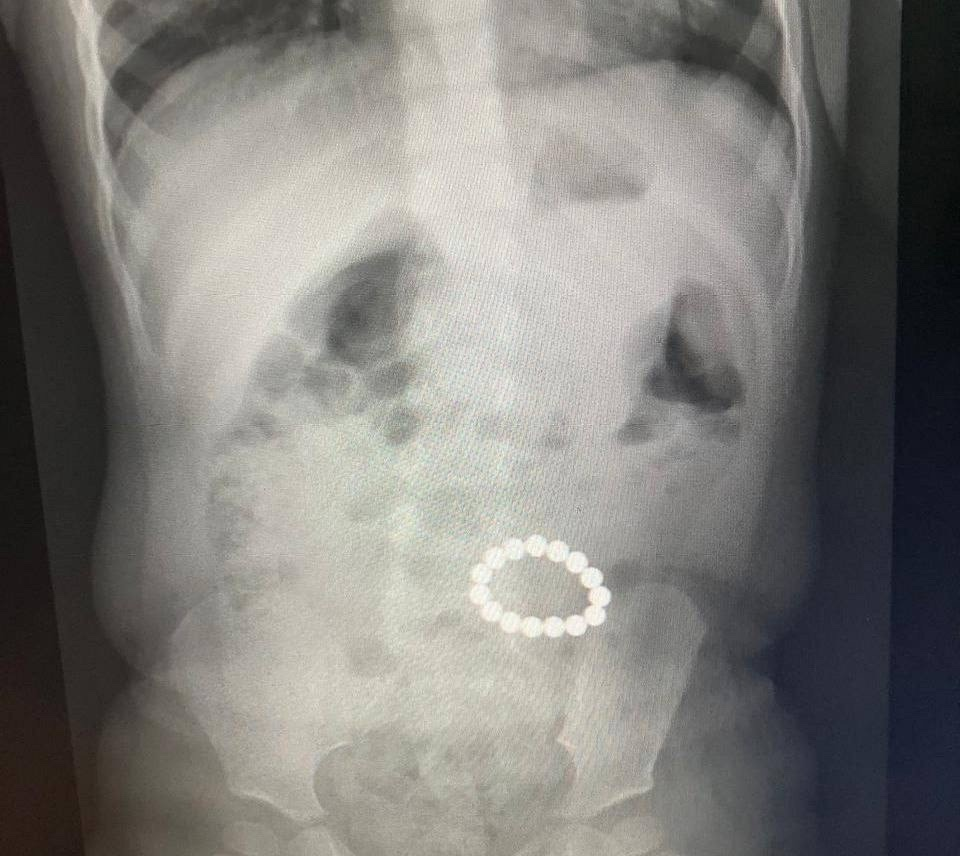 Be careful, magnetic balls: Surgeons at the G. N. Speransky Children's Hospital saved a baby who swallowed 15 of them - Treatment, The medicine, Moscow, Operation, Foreign object, Children, Toys