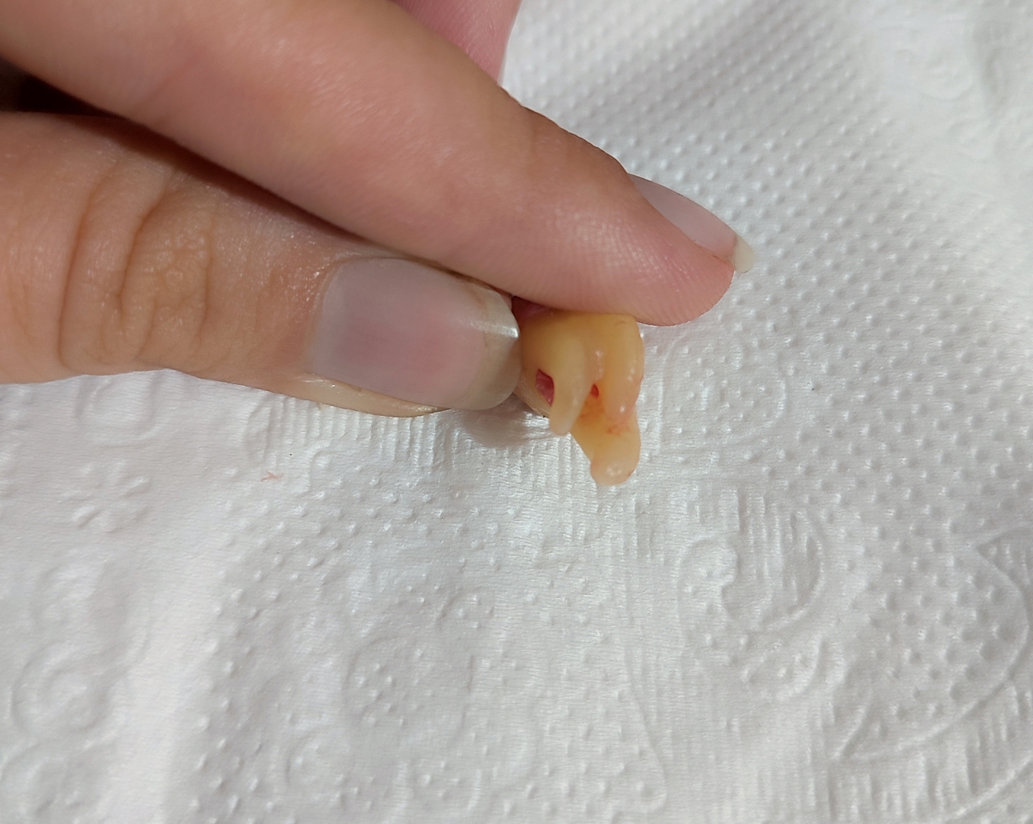 Do you want to know where I got these scars from? - My, Teeth, Wisdom tooth, Mat, Treatment, Longpost