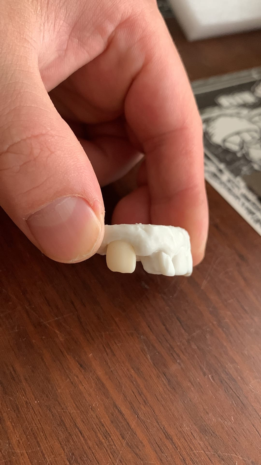 A saga about dentistry. Chapter 89. What to do if there is no money for a normal crown? - My, Dentistry, Doctors, The medicine, Answer, Health, 3D, CNC, 3D печать, 3D modeling, 3D printer, Crown, Machine, Dentist, Prosthetics, No money, Teeth, Problem, Treatment, Polyclinic, Consultation, Longpost, Lord of the Rings