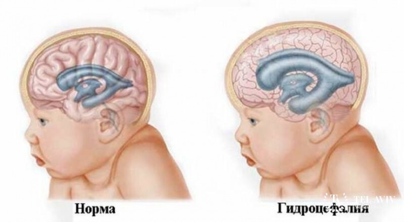 I am a boy who survived hydrocephalus in its final stages - My, Hydrocephalus, Disabled person, Longpost