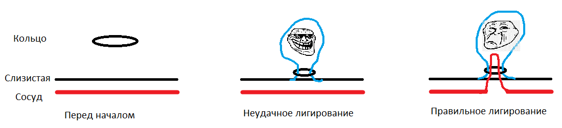 Как закалялась сталь, или Лигирование геморроидальных узлов - Моё, Геморрой, Медицина, Операция, Лечение, Видео, YouTube, Длиннопост