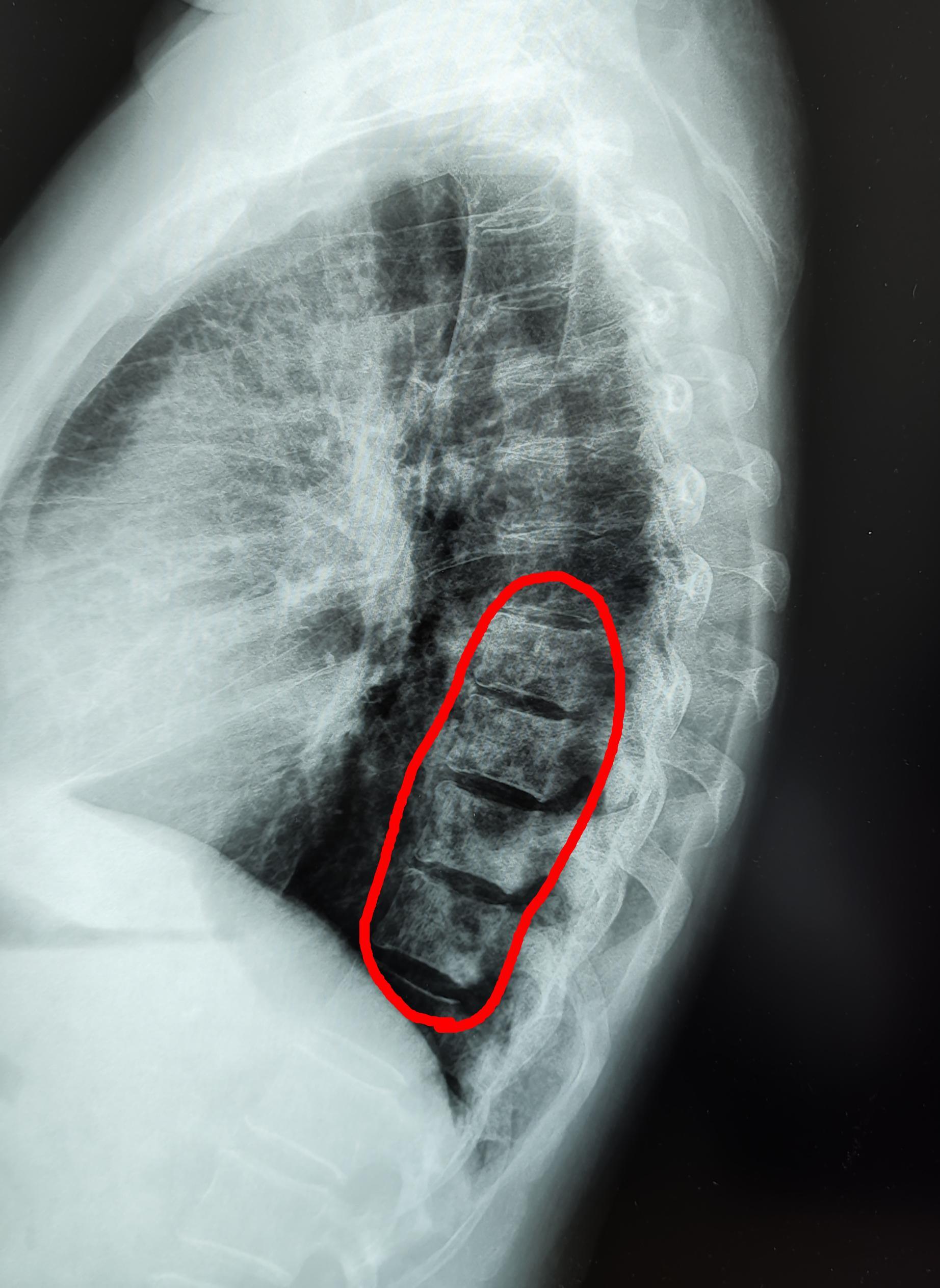 Lung cancer with metastases to the spine - My, The medicine, Army, Cancer and oncology, Metastases, Military enlistment office, X-ray, Radiology, Longpost