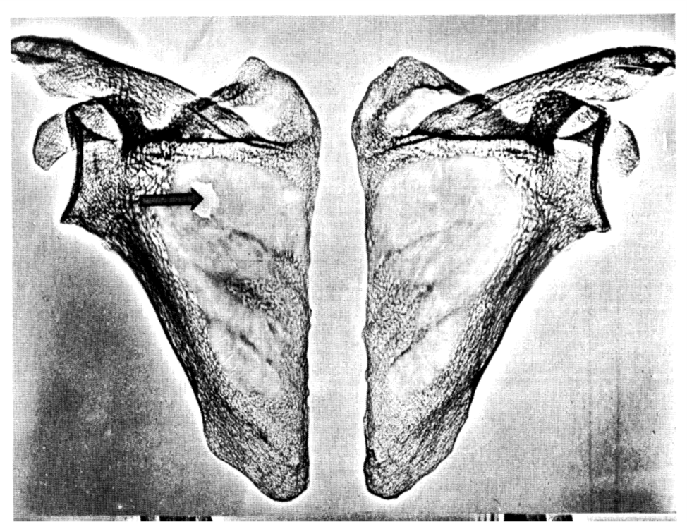 Medieval wounds. Death of Two Kings, Survivor's Fallacy and Survival - My, Military history, Archeology, Crusaders, Middle Ages, Skeleton, The medicine, Mat, Longpost