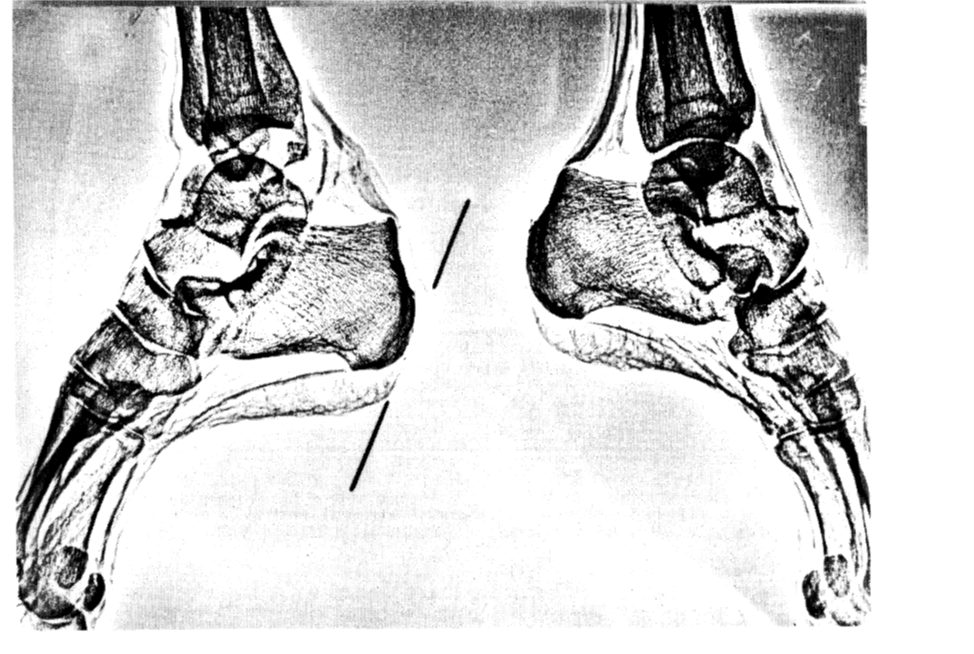 Medieval wounds. Death of Two Kings, Survivor's Fallacy and Survival - My, Military history, Archeology, Crusaders, Middle Ages, Skeleton, The medicine, Mat, Longpost