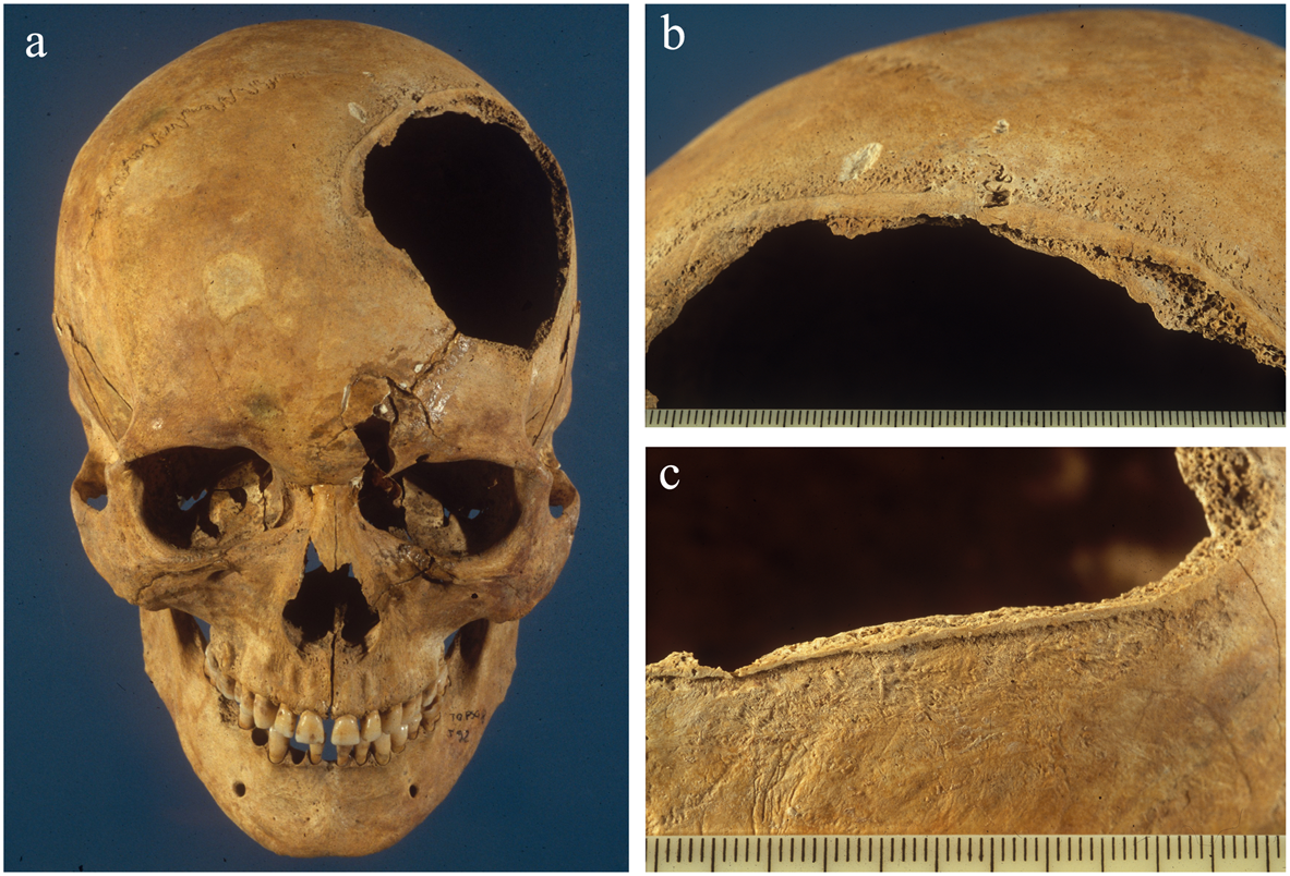 Medieval wounds. Death of Two Kings, Survivor's Fallacy and Survival - My, Military history, Archeology, Crusaders, Middle Ages, Skeleton, The medicine, Mat, Longpost