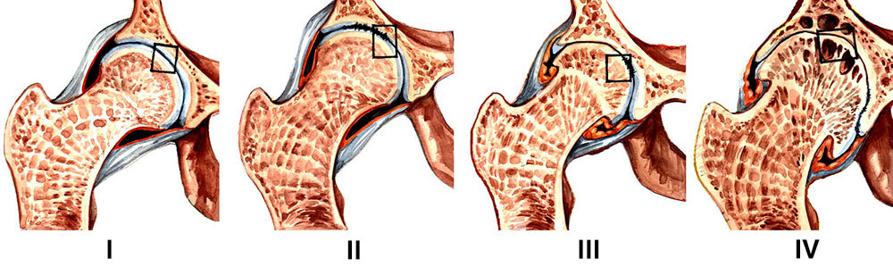 Radiological classifications of osteoarthritis - My, The medicine, Army, X-ray, Radiology, Gonarthrosis, Joints, Military enlistment office, The appeal, Longpost