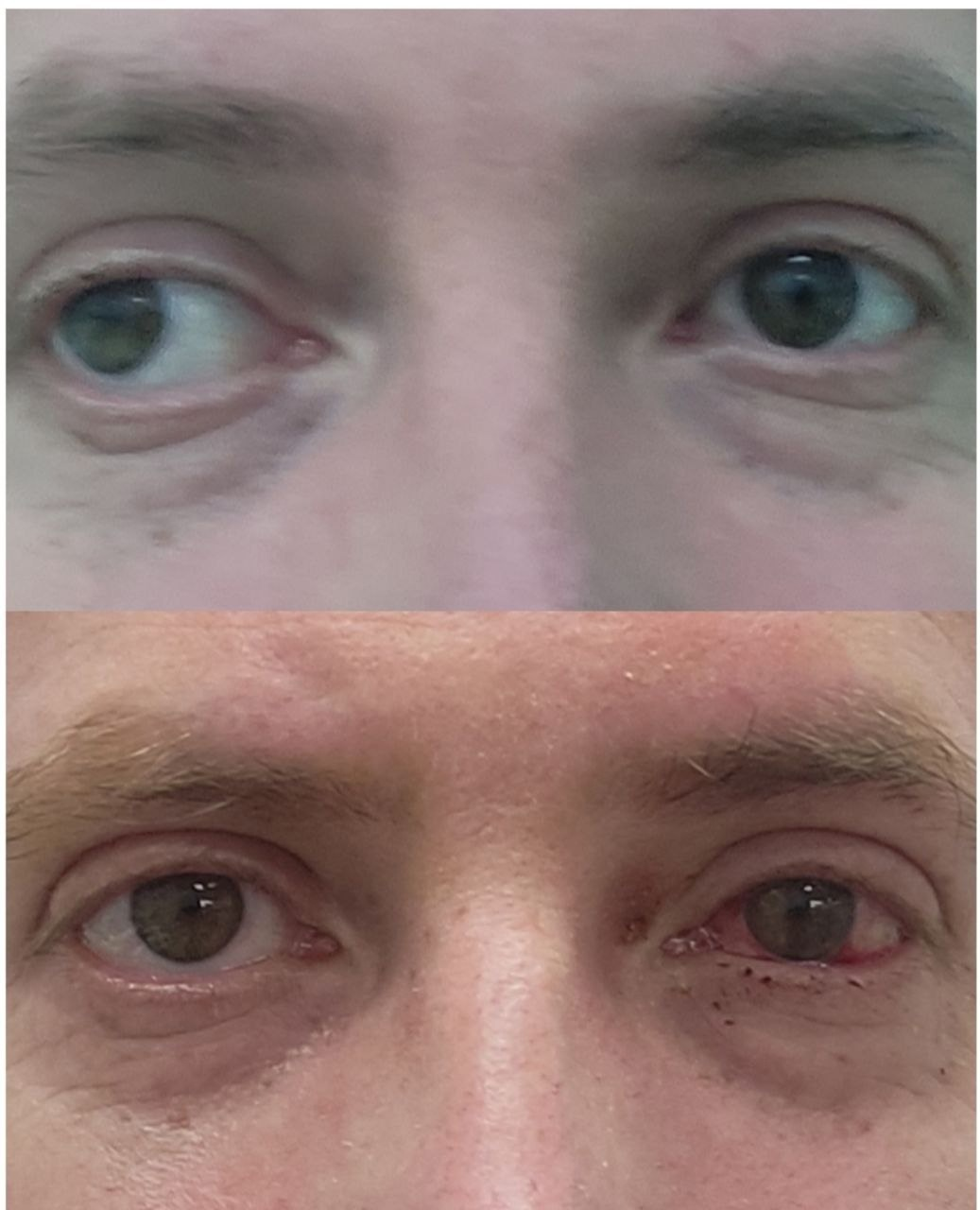 The result of surgical treatment with friendly divergent strabismus - My, The medicine, Doctors, Treatment, Operation, Strabismus, Ophthalmology, Eyes, Telegram (link), VKontakte (link)