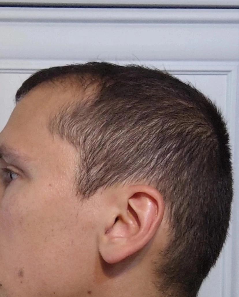 One year after hair transplant - My, Hair Transplant, Alopecia, Longpost