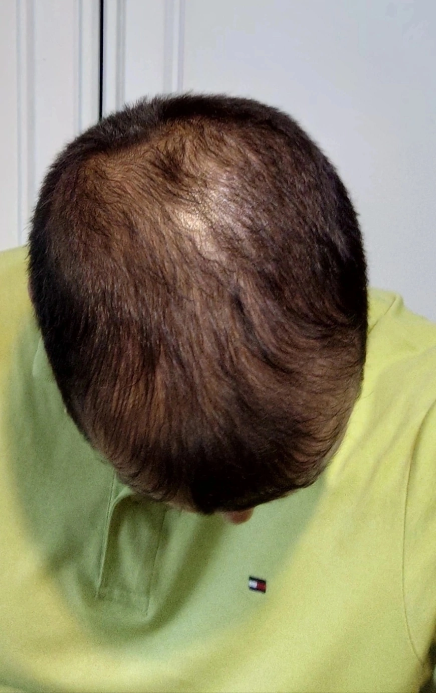 One year after hair transplant - My, Hair Transplant, Alopecia, Longpost