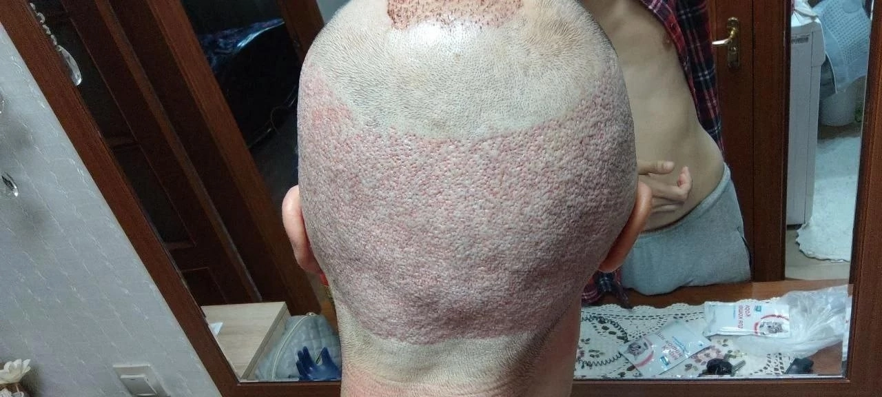 One year after hair transplant - My, Hair Transplant, Alopecia, Longpost