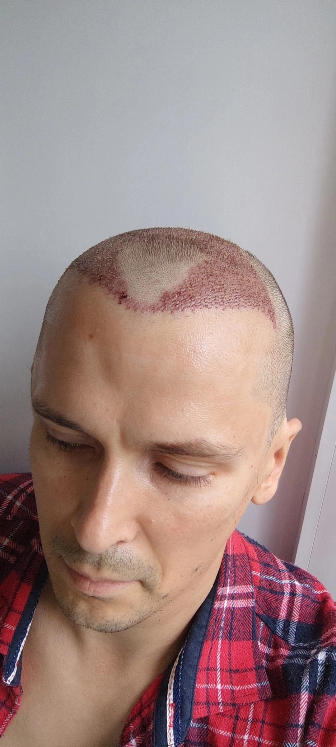 One year after hair transplant - My, Hair Transplant, Alopecia, Longpost