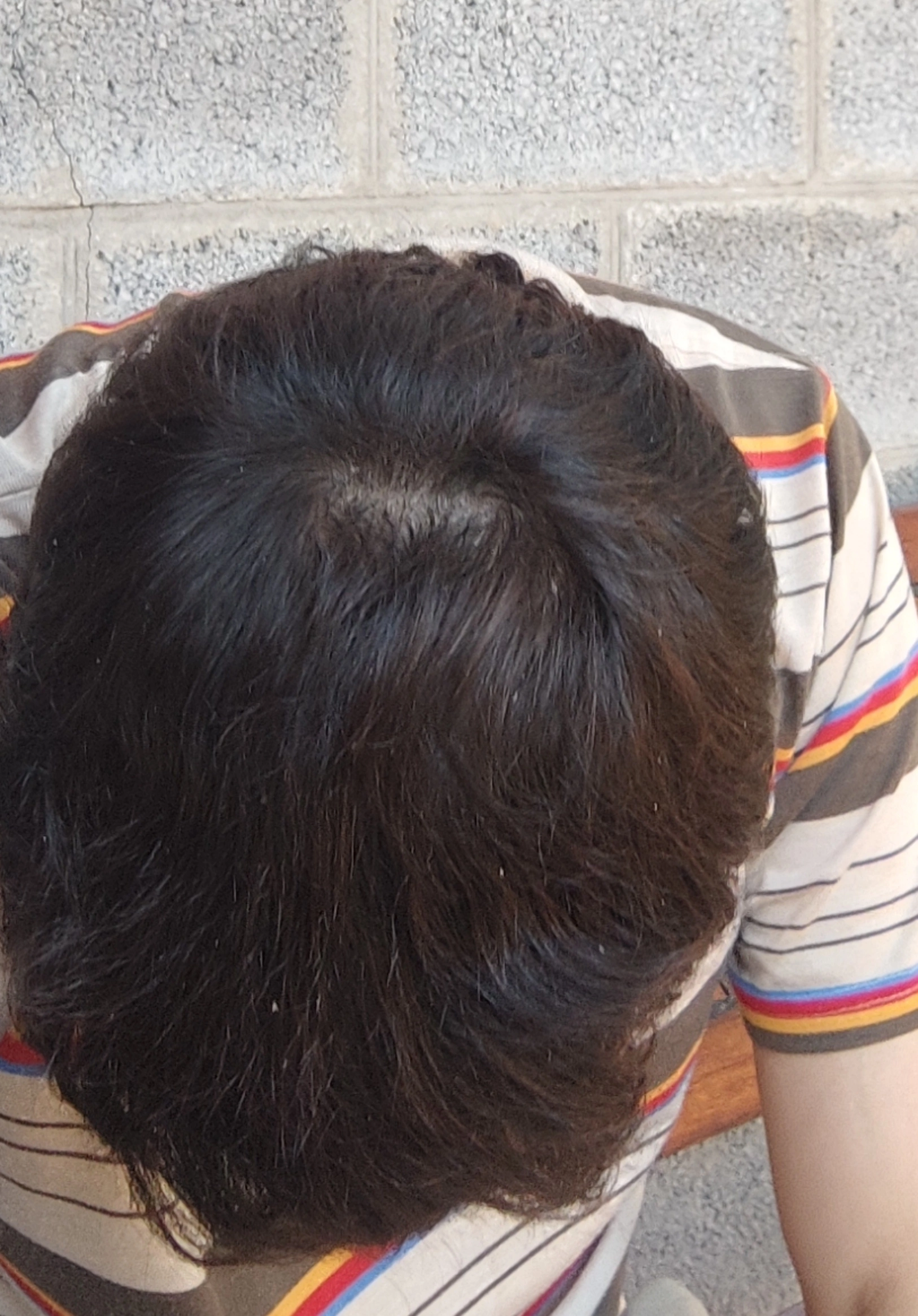 One year after hair transplant - My, Hair Transplant, Alopecia, Longpost