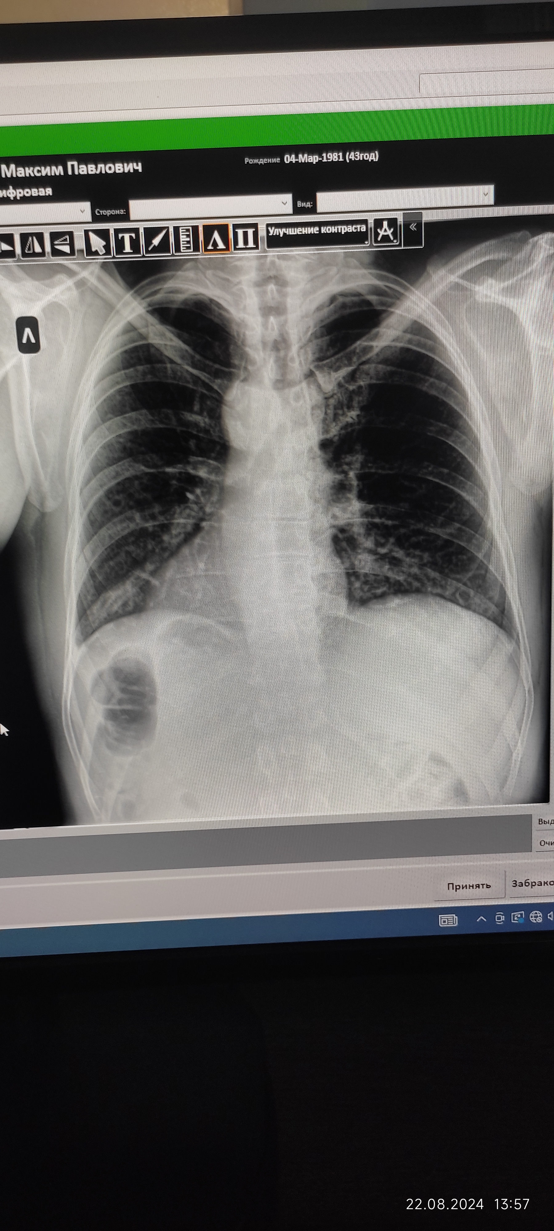 Need help from a radiologist and traumatologist - My, Fracture, Injury, Longpost, X-ray, Doctors need help