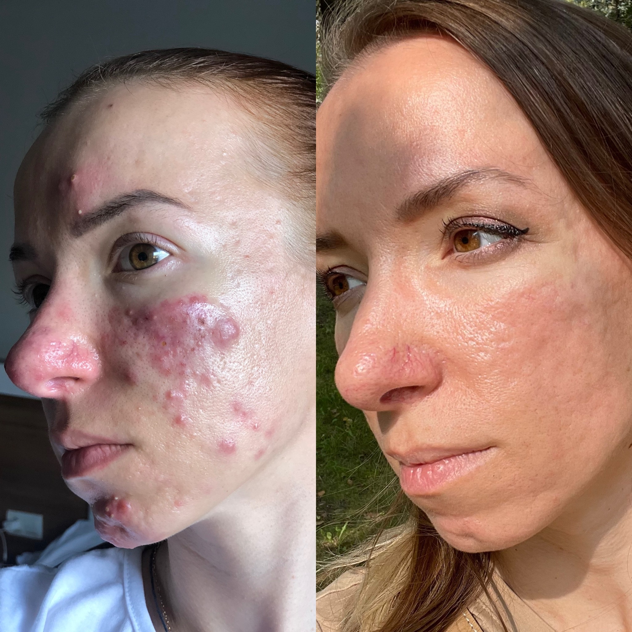 My path to clear skin from stage 4 acne - My, Health, Acne, Acne, Medications, Cosmetics, Natural cosmetics, Treatment, Longpost, Disease history