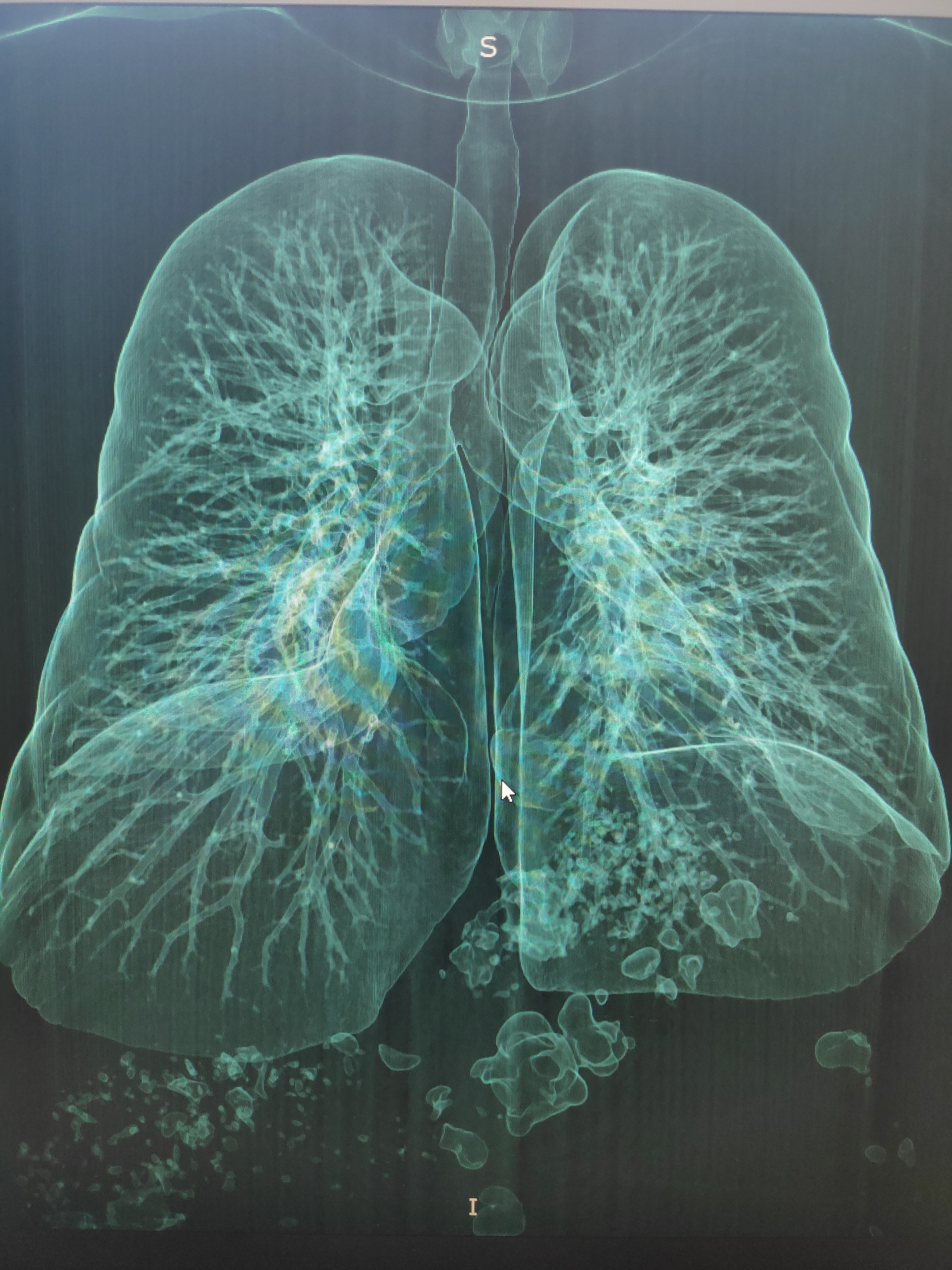 My lungs... - My, CT, Lungs, Pneumonia, Health, Video, Longpost