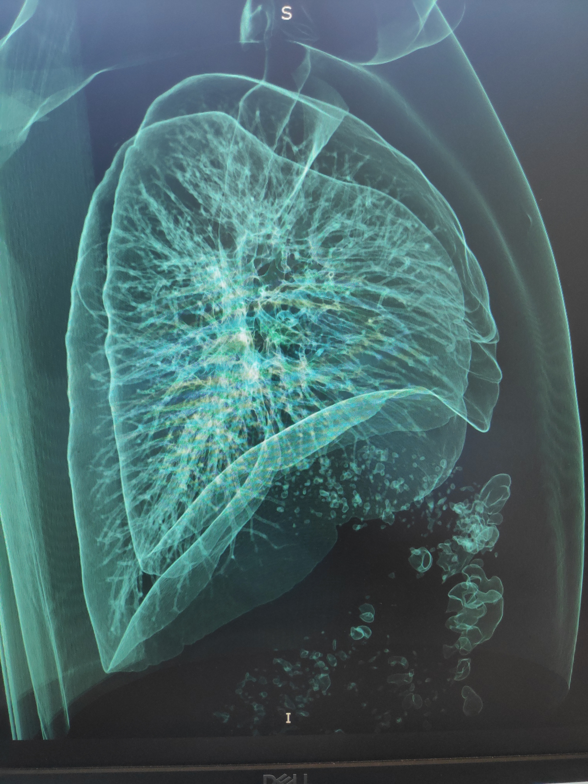 My lungs... - My, CT, Lungs, Pneumonia, Health, Video, Longpost