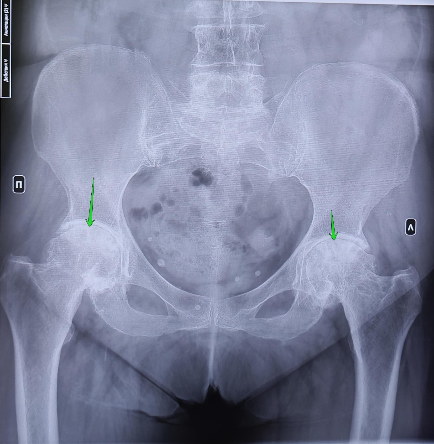 Aseptic necrosis of the femoral heads - My, The medicine, Army, Military enlistment office, Conscripts, X-ray, Radiology, Traumatology, Orthopedics, Necrosis, Joints, Endoprosthetics, Longpost