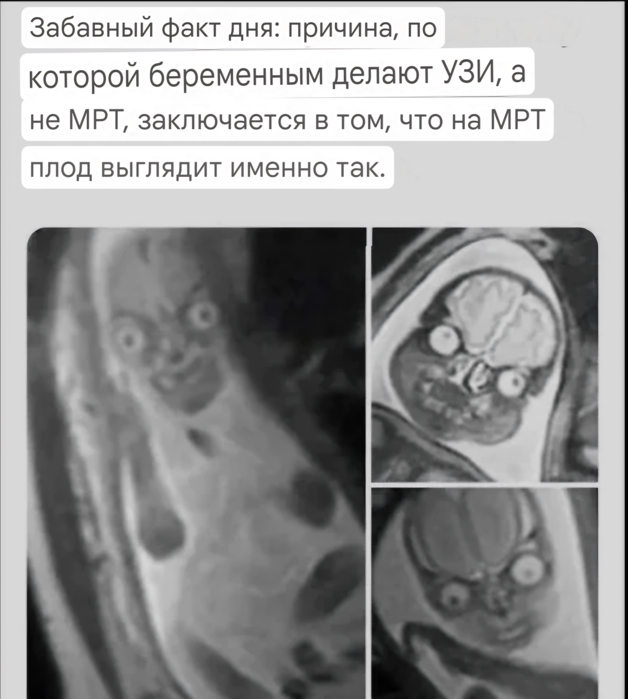 Fetus - Humor, Picture with text, MRI, Pregnancy, Repeat