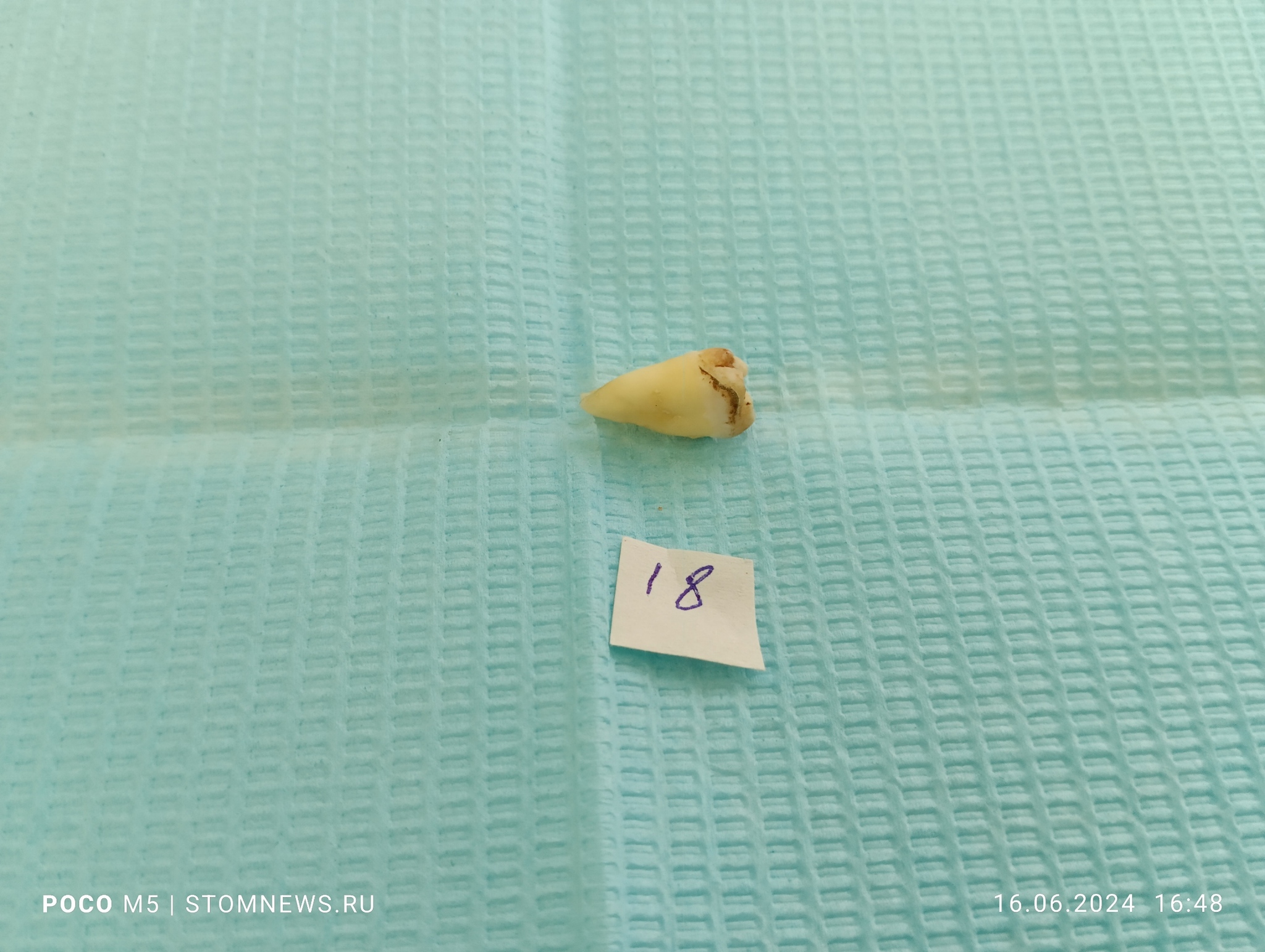 Removed 18th wisdom tooth with caries on the vestibular surface - My, The medicine, Dentistry, Doctors, Teeth, Medications, Polyclinic, Treatment, Operation, Longpost