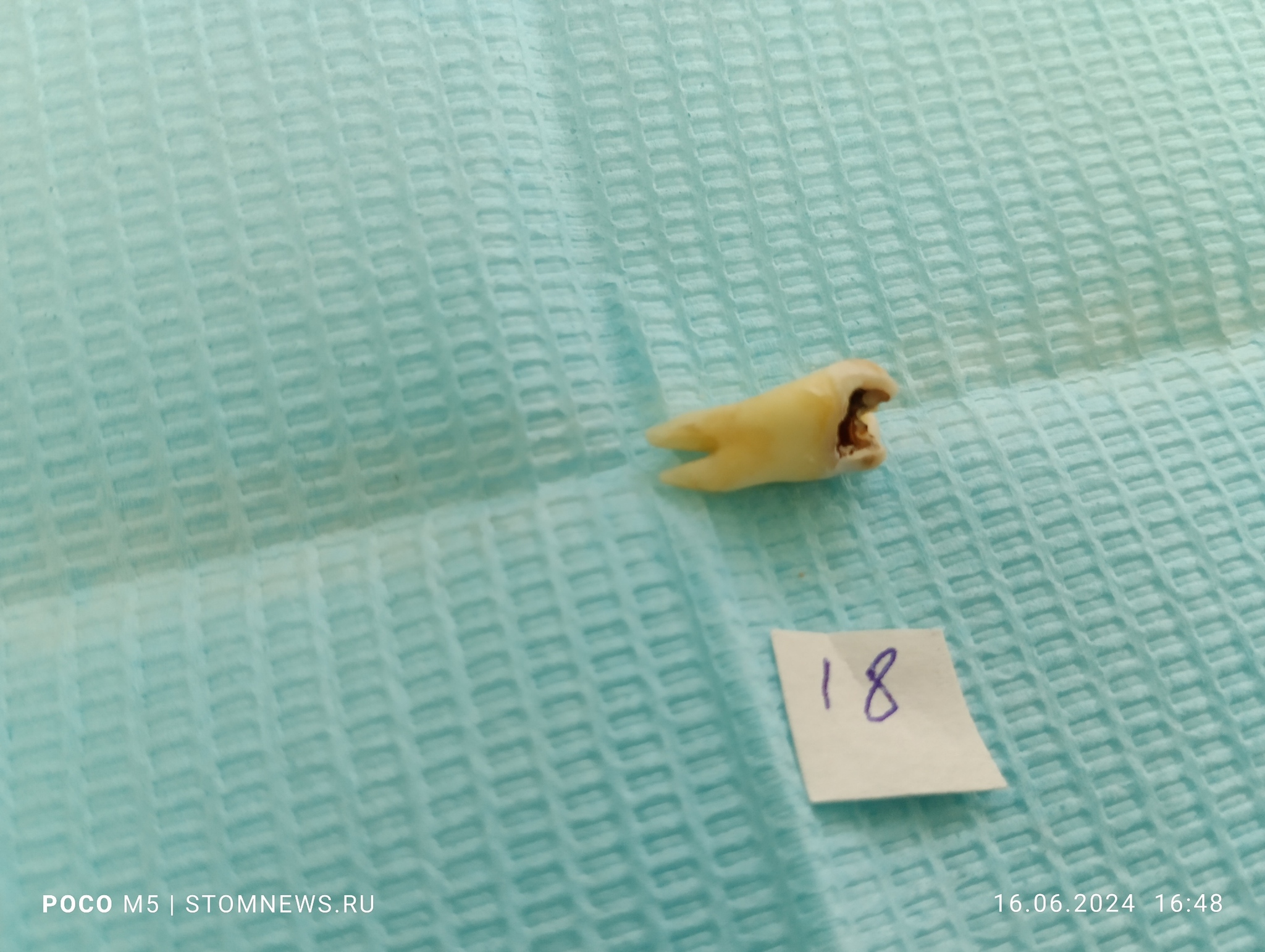 Removed 18th wisdom tooth with caries on the vestibular surface - My, The medicine, Dentistry, Doctors, Teeth, Medications, Polyclinic, Treatment, Operation, Longpost