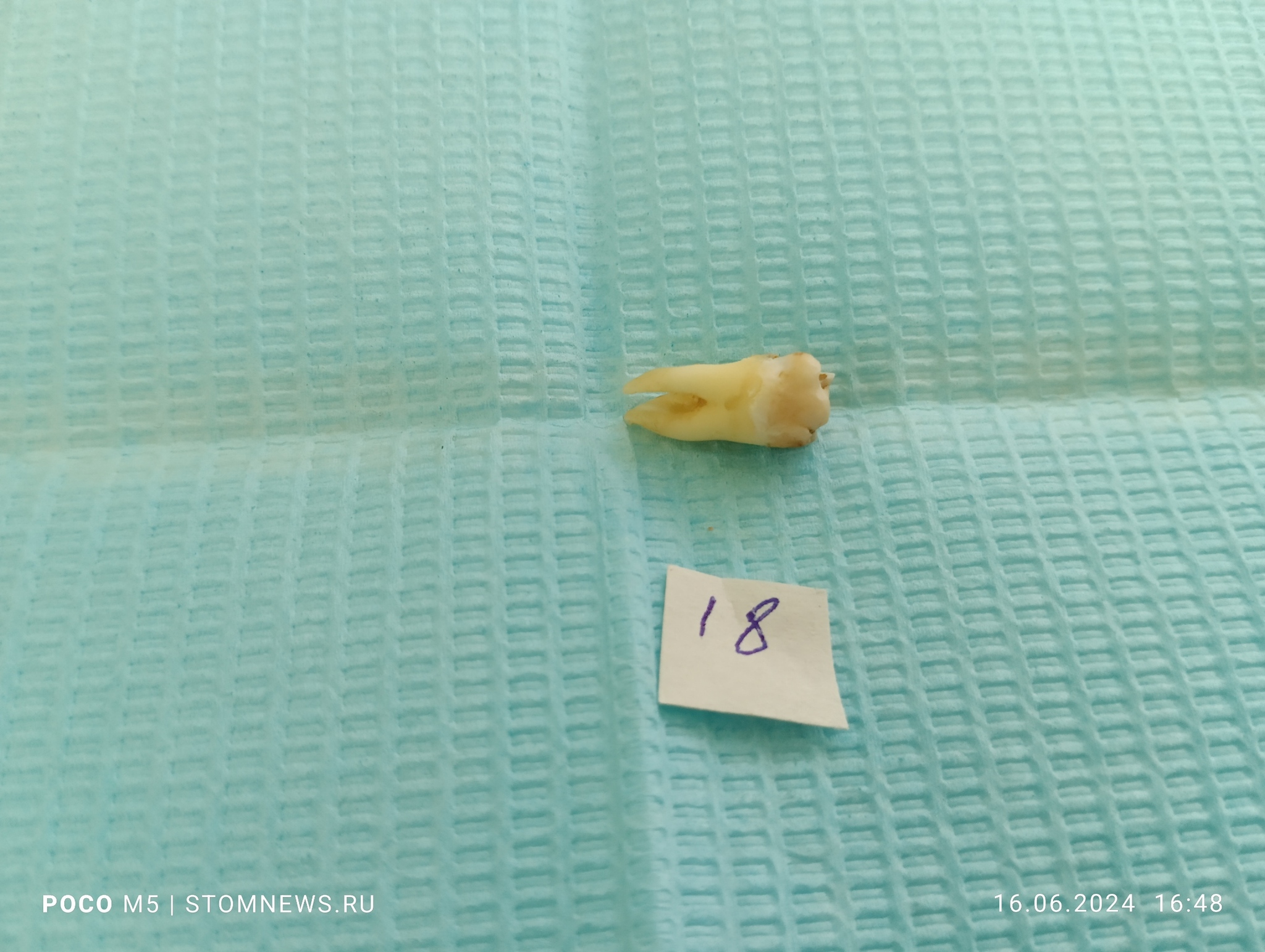 Removed 18th wisdom tooth with caries on the vestibular surface - My, The medicine, Dentistry, Doctors, Teeth, Medications, Polyclinic, Treatment, Operation, Longpost